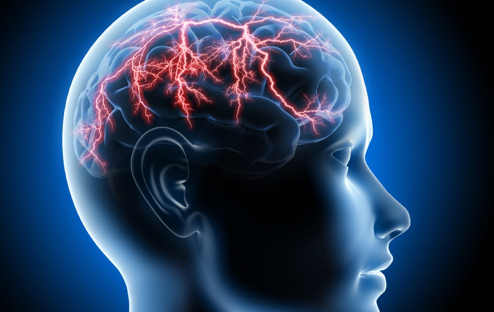 3D illustration of a man experiencing a stroke, showing the brain with blood vessel blockage, representing the disruption of blood flow and potential damage to the brain caused by the stroke.